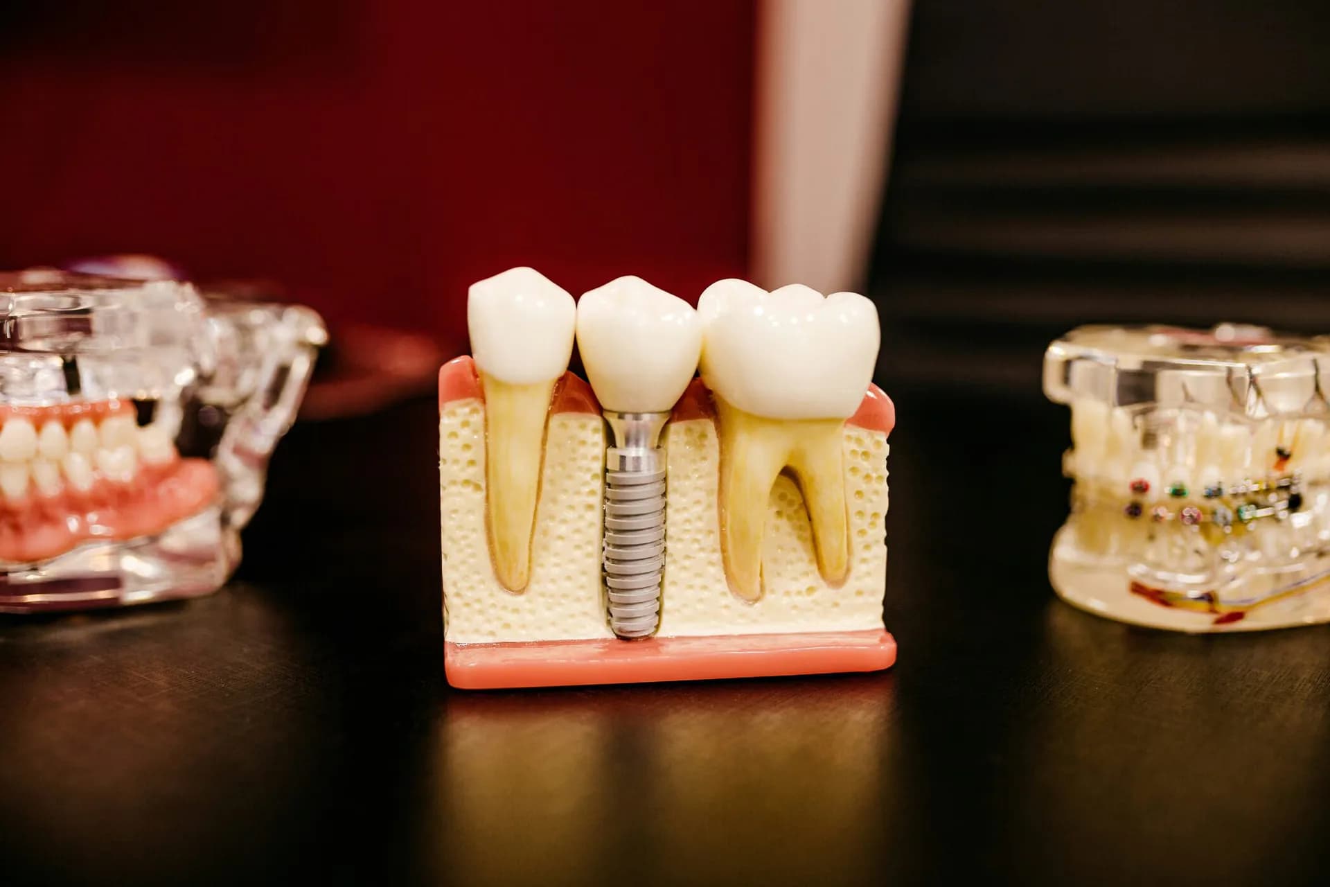 Dental Implants in Dubai: Timeline, Healing and Aftercare